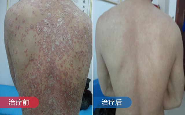 偏方治疗银屑病,为何25年仍未康复?